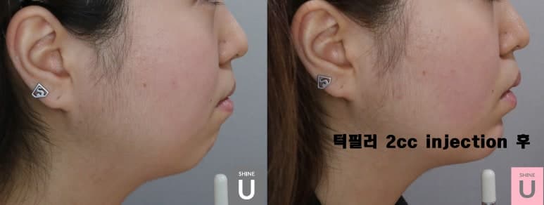 엘란쎄 필러, 콜라겐 재생형 볼륨의 원리